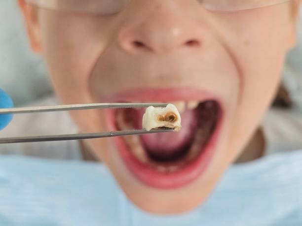 Best Emergency Gum Treatment in South St Paul, MN